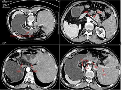 Case report: Laparoscopic-assisted distal gastrectomy for gastric cancer in a patient with situs inversus totalis